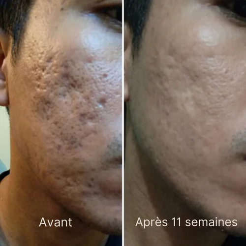 Stick Cicatris™ – Pour une peau visiblement plus lisse