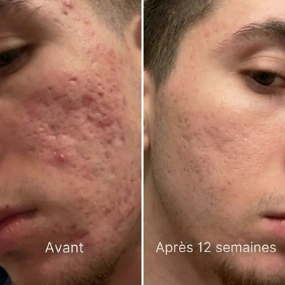 Stick Cicatris™ – Pour une peau visiblement plus lisse