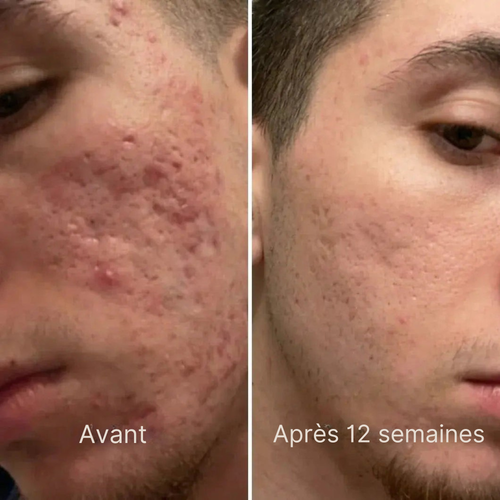 Stick Cicatris™ – Pour une peau visiblement plus lisse